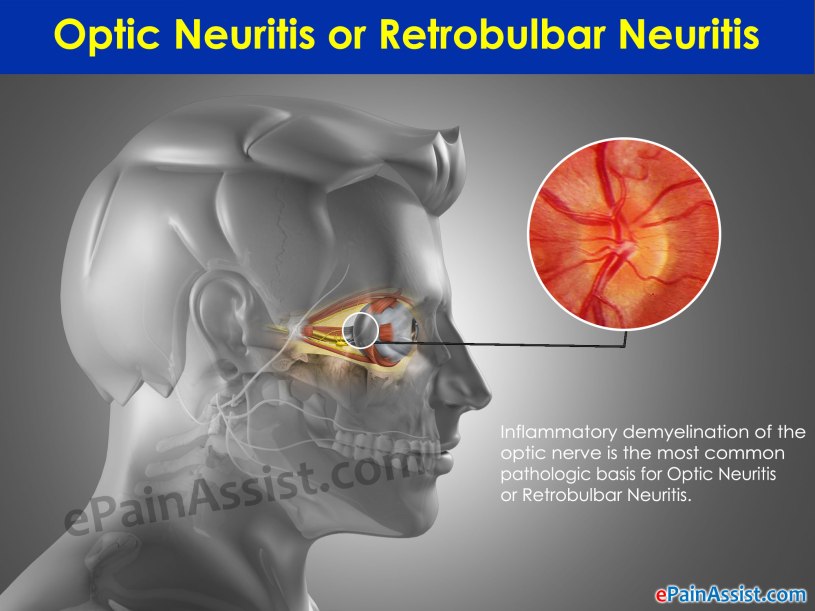 optic-neuritis